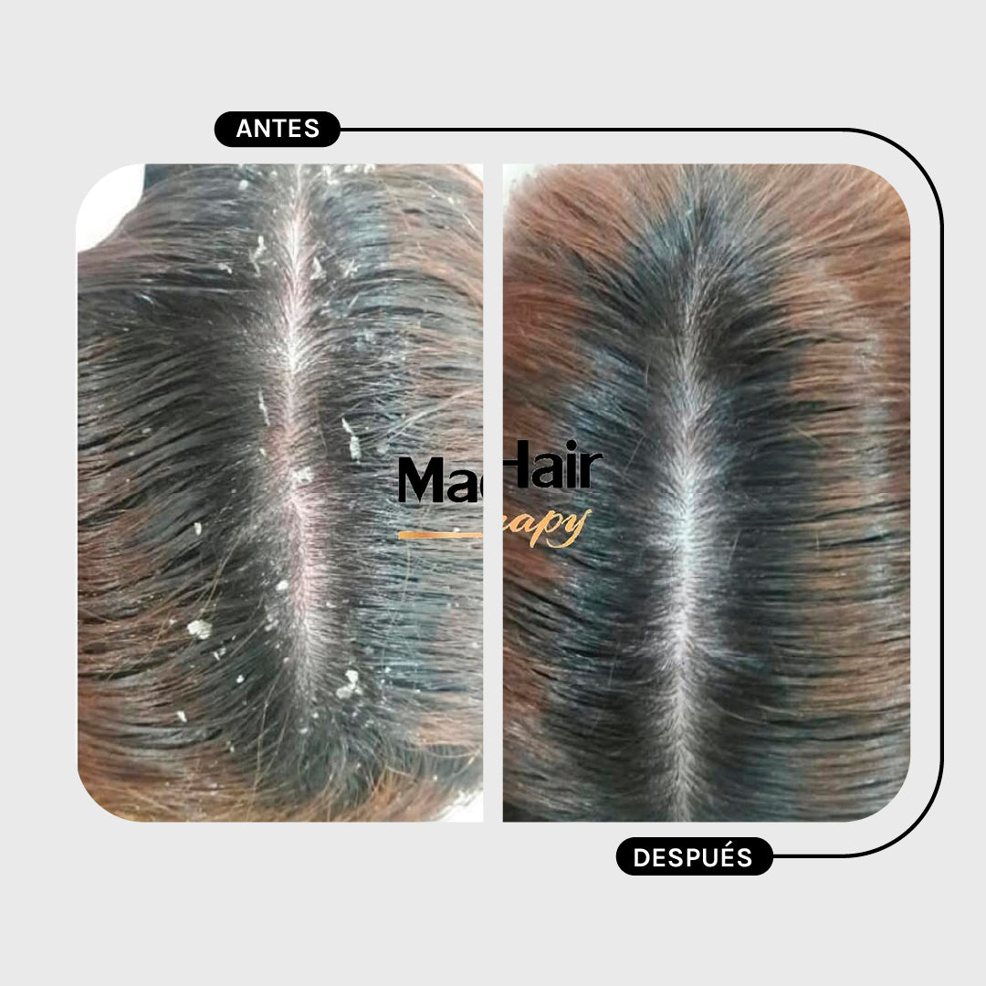 SHAMPOO CONTROL CASPA