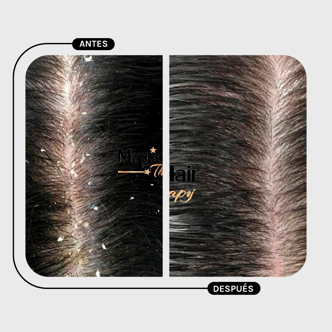 ACONDICIONADOR ANTICASPA