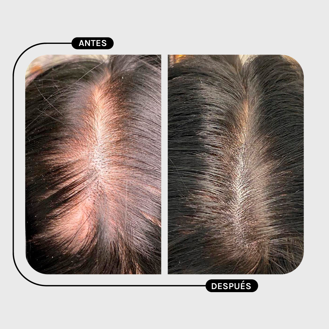 TRATAMIENTO CALÉNDULA